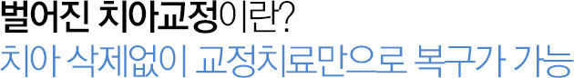 벌어진치아 교정이란?