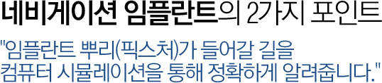 네비게이션 임플란트
