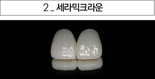 세라믹크라운